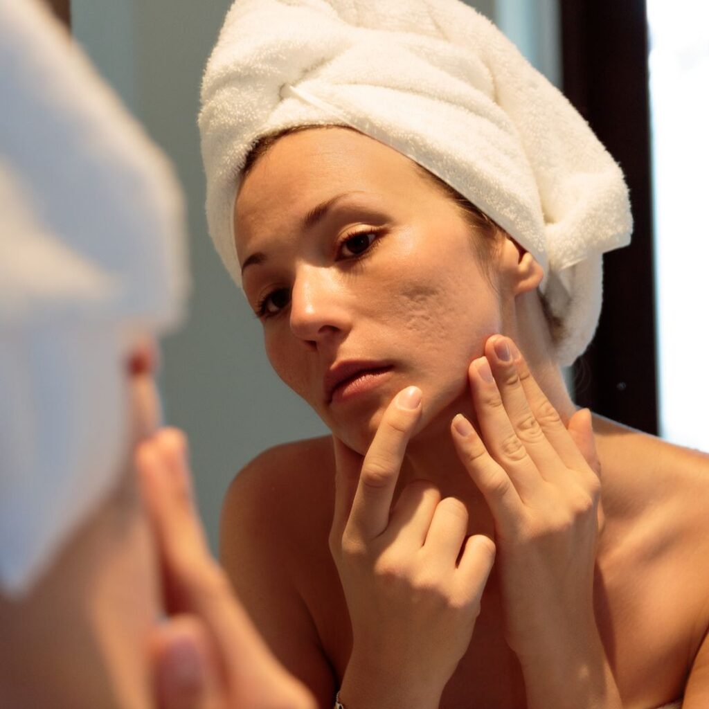 woman looking her acne scars on the mirror