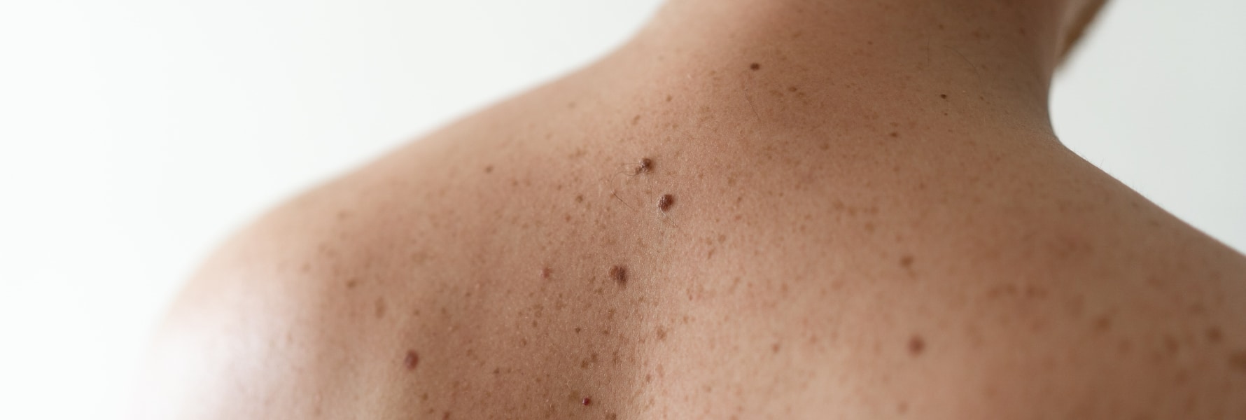 upper back with moles