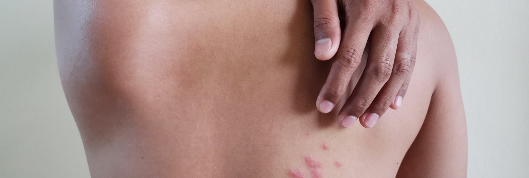 individual’s hand scratching shingles rash on back