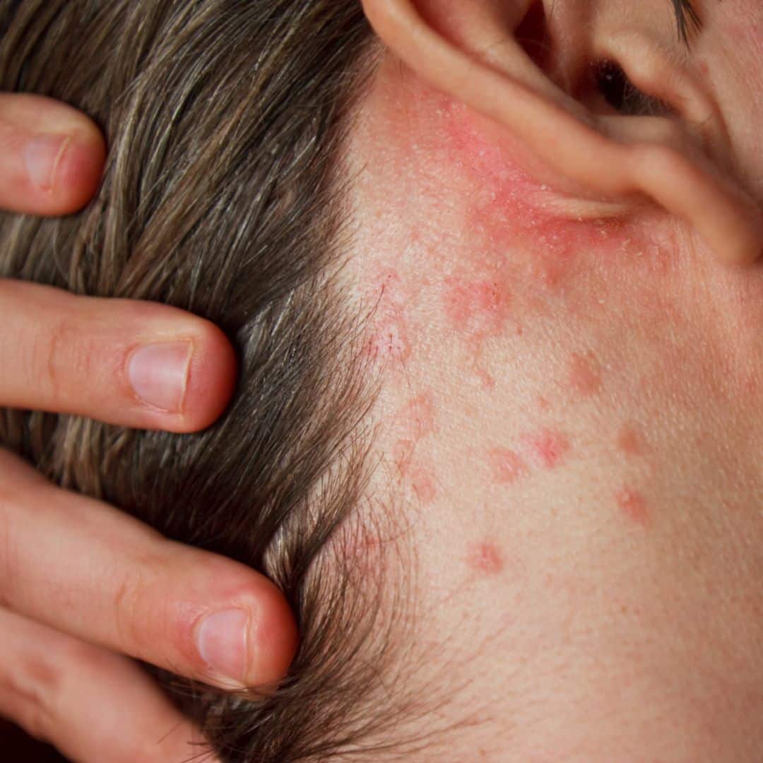 Shingles on neck