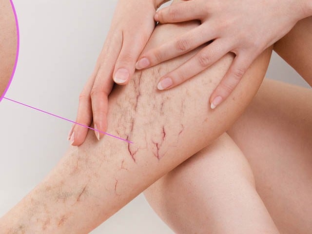 the dilation of small blood vessels of the skin on the leg
