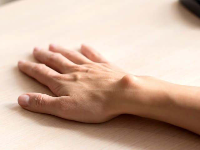 Wrist in the table with ganglion cyst