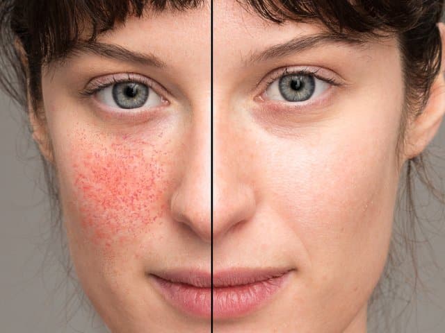 A before and after view of a Caucasian girl suffering with rosacea.