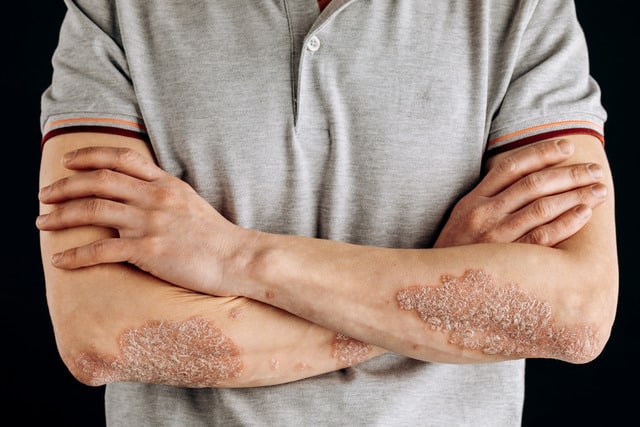 Psoriasis awareness