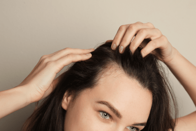 alopecia areata hair loss
