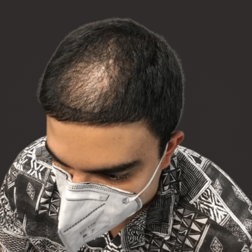 Hair Restoration at Plantation Dermatology Before
