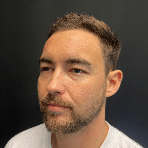 Plantation Hair Restoration After