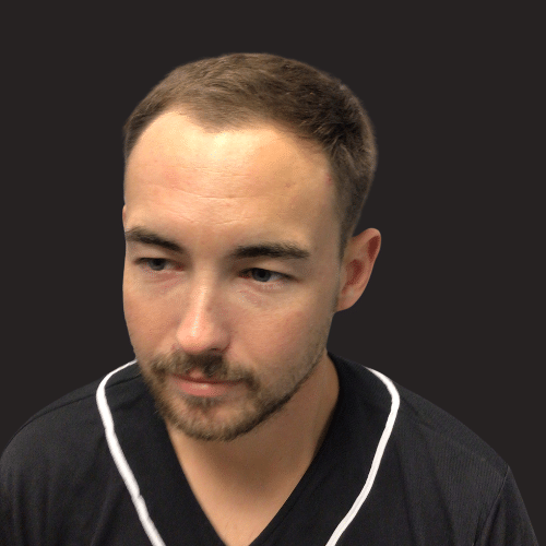 Plantation Hair Restoration Before