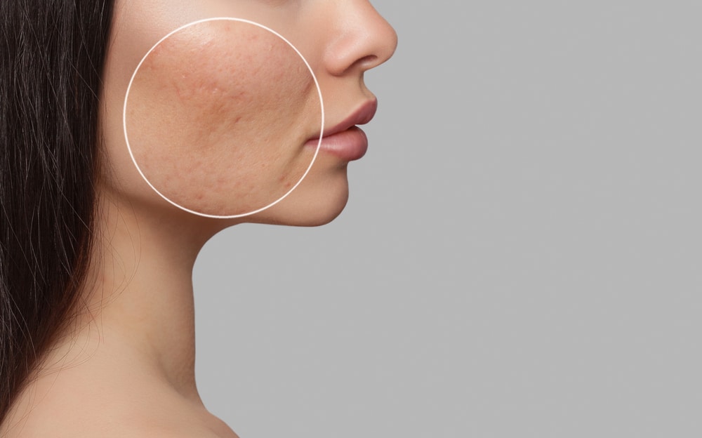 Woman, turned to the side, reveals a cheek with prominent acne scars before treatment at her dermatologist’s office