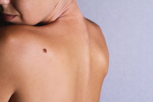 Checking benign moles : Young woman looking with birthmark on her back / skin