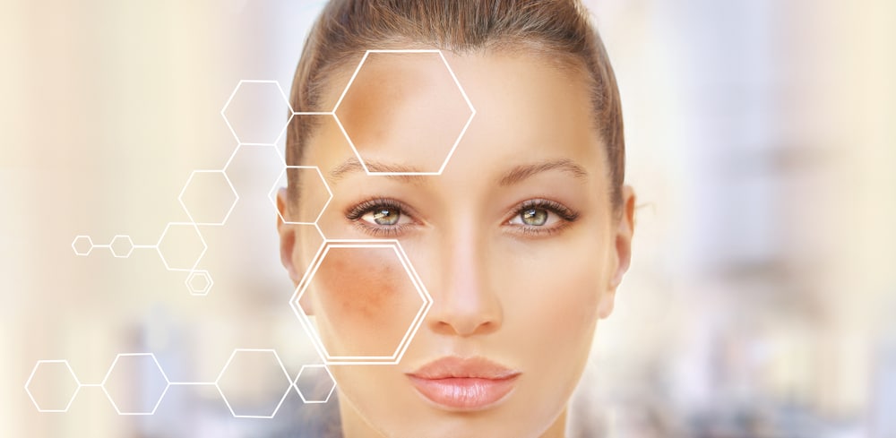 Beautiful woman with melasma, showing dark patches on her cheeks and forehead