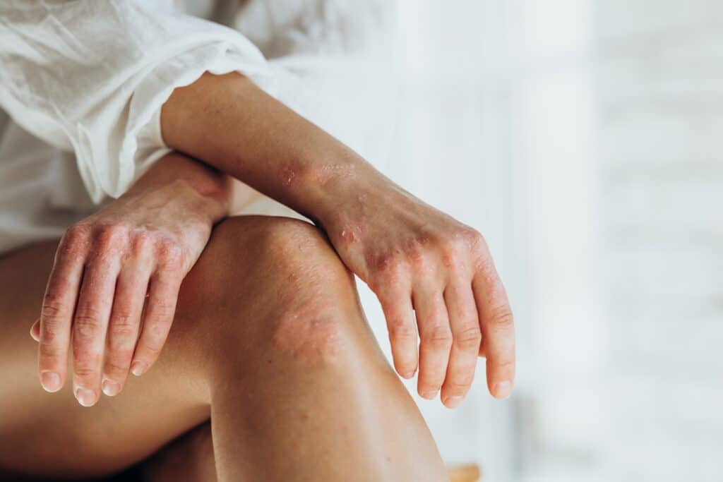 Woman poses with legs crossed, reveal psoriasis plaques on her hands and knees