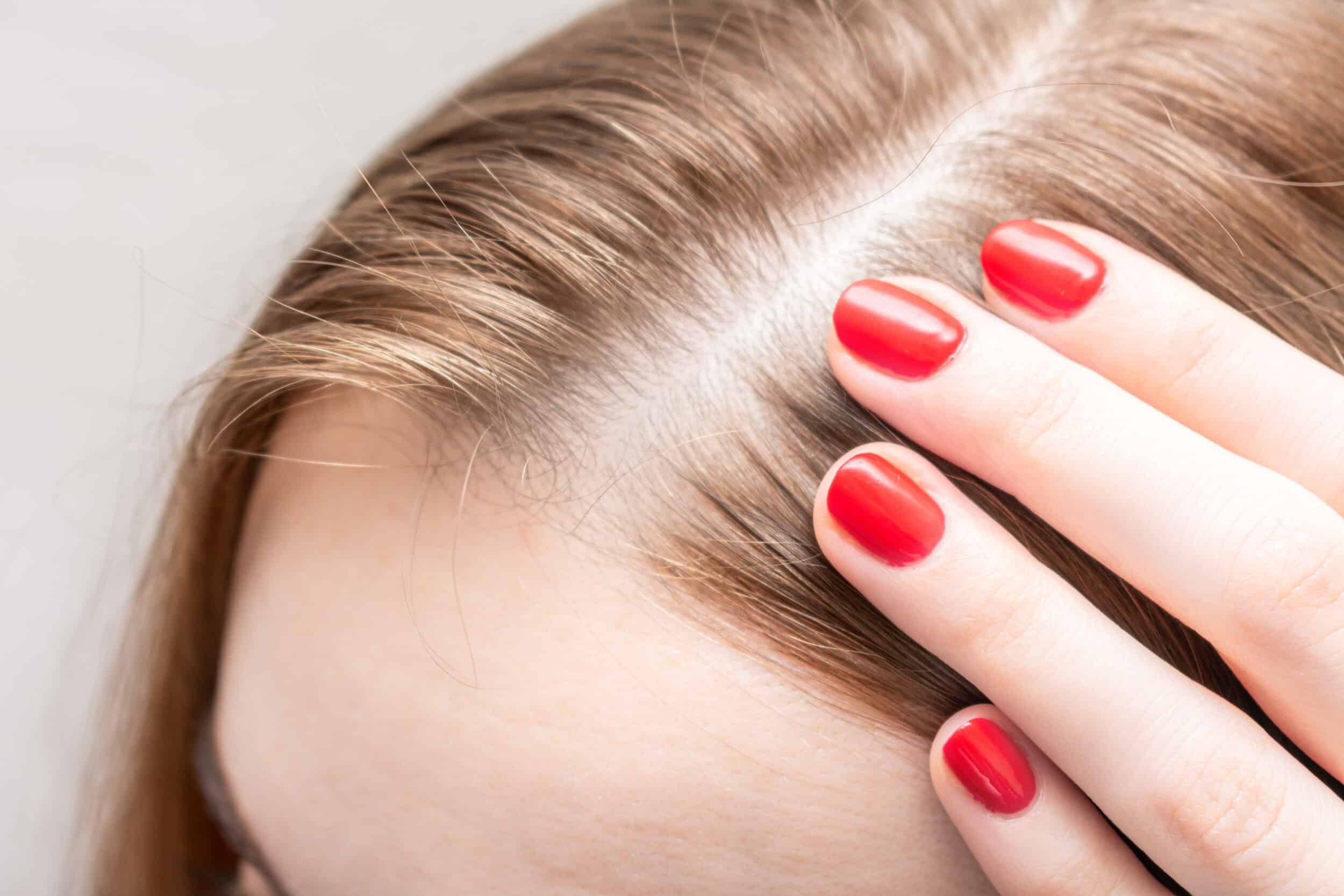 Woman parts her hair, showing a widening of her part, before NeoGraft® hair restoration