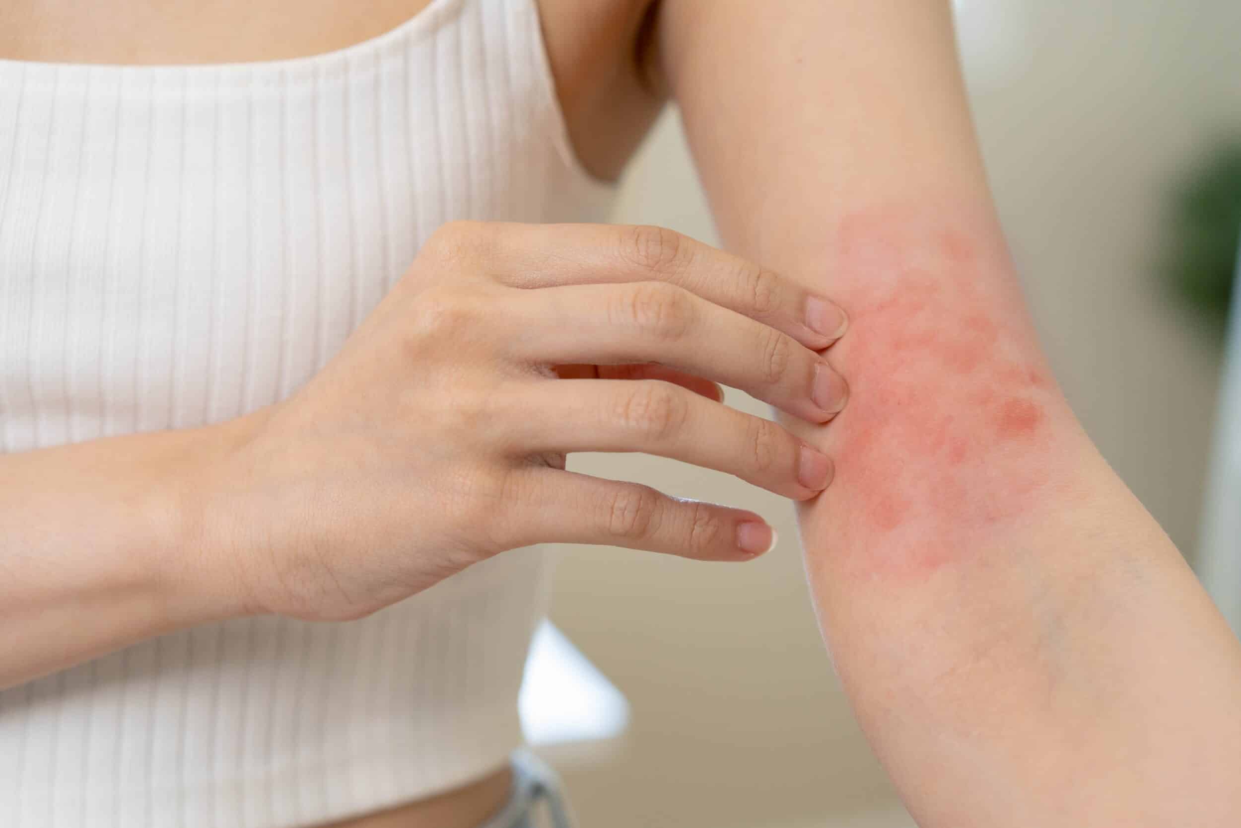 Woman extends her bare arm, revealing angry-looking red skin after an eczema flare-up