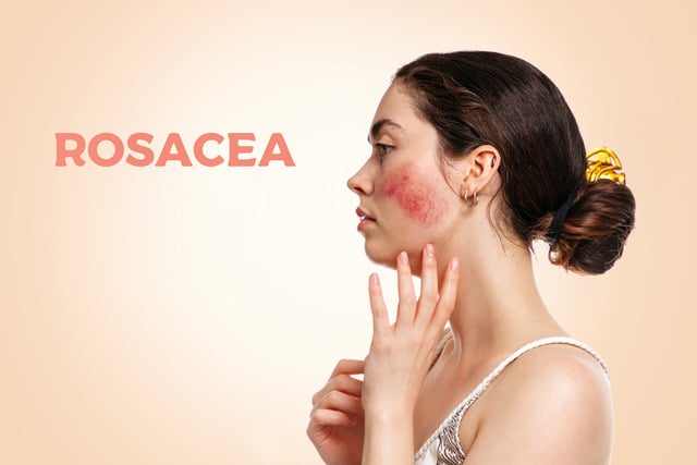 Young woman's profile view, revealing red cheeks due to rosacea sun exposure in Plantation