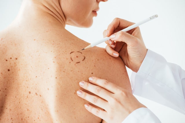 A dermatologist examining a patient's skin for early signs of melanoma